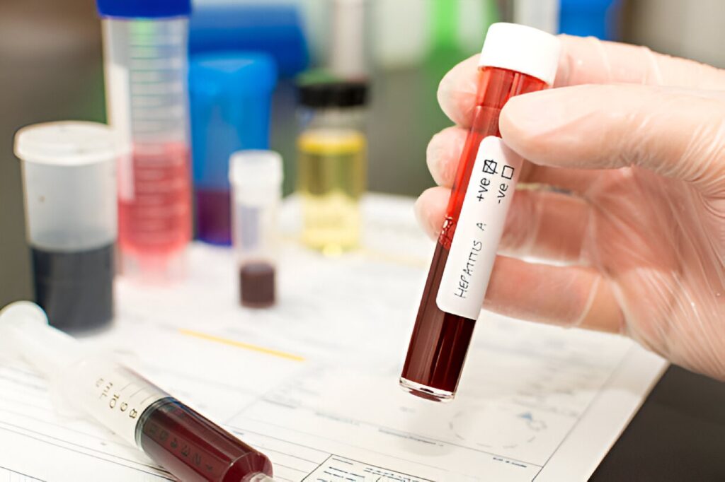 Herpes Tests in Dubai