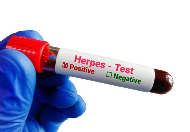 Herpes Test