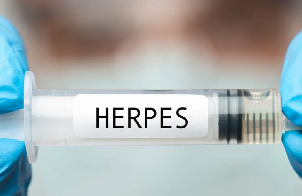 herpes test